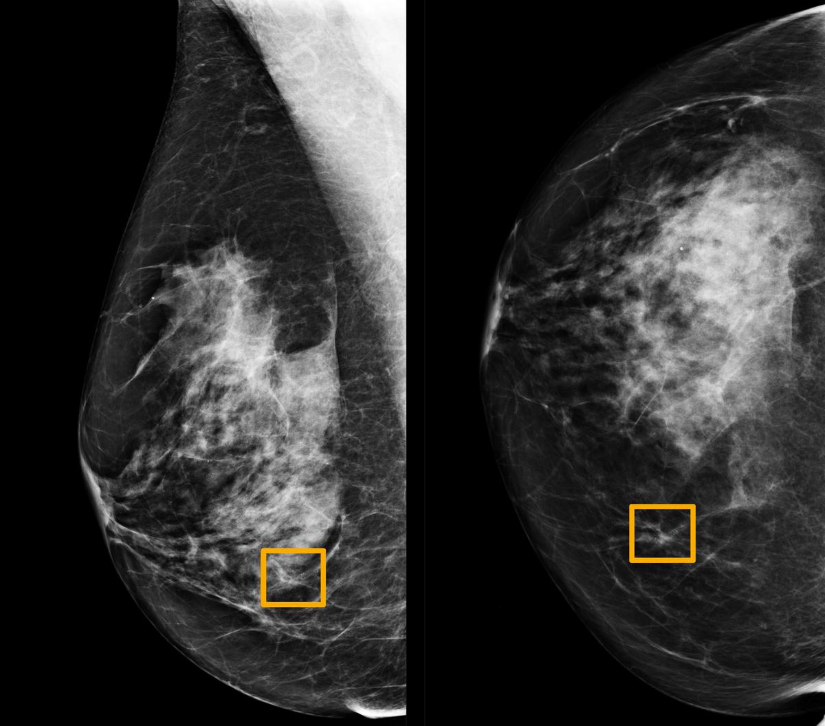 đ Artificiell Intelligens ökar trĂ€ffsĂ€kerheten vid diagnos av bröstcancer