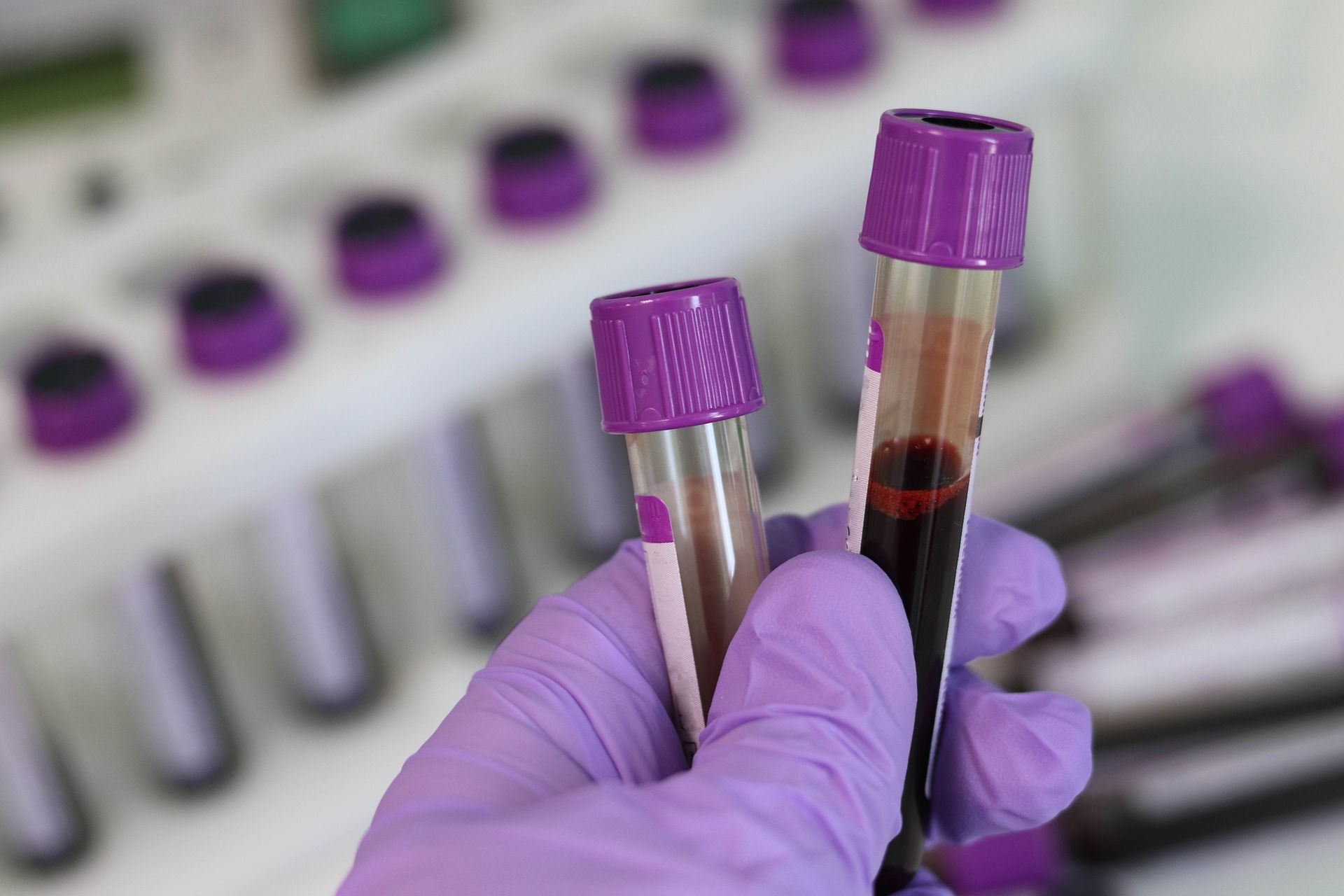 đ Blodprov kan ge sĂ€krare och snabbare diagnos av Alzheimers