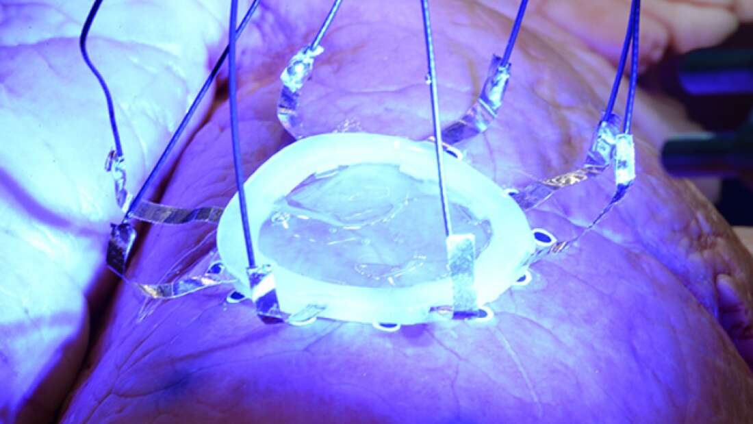 đ©č 3D-printing direkt pĂ„ organ revolutionerar medicinsk behandling och kontroll