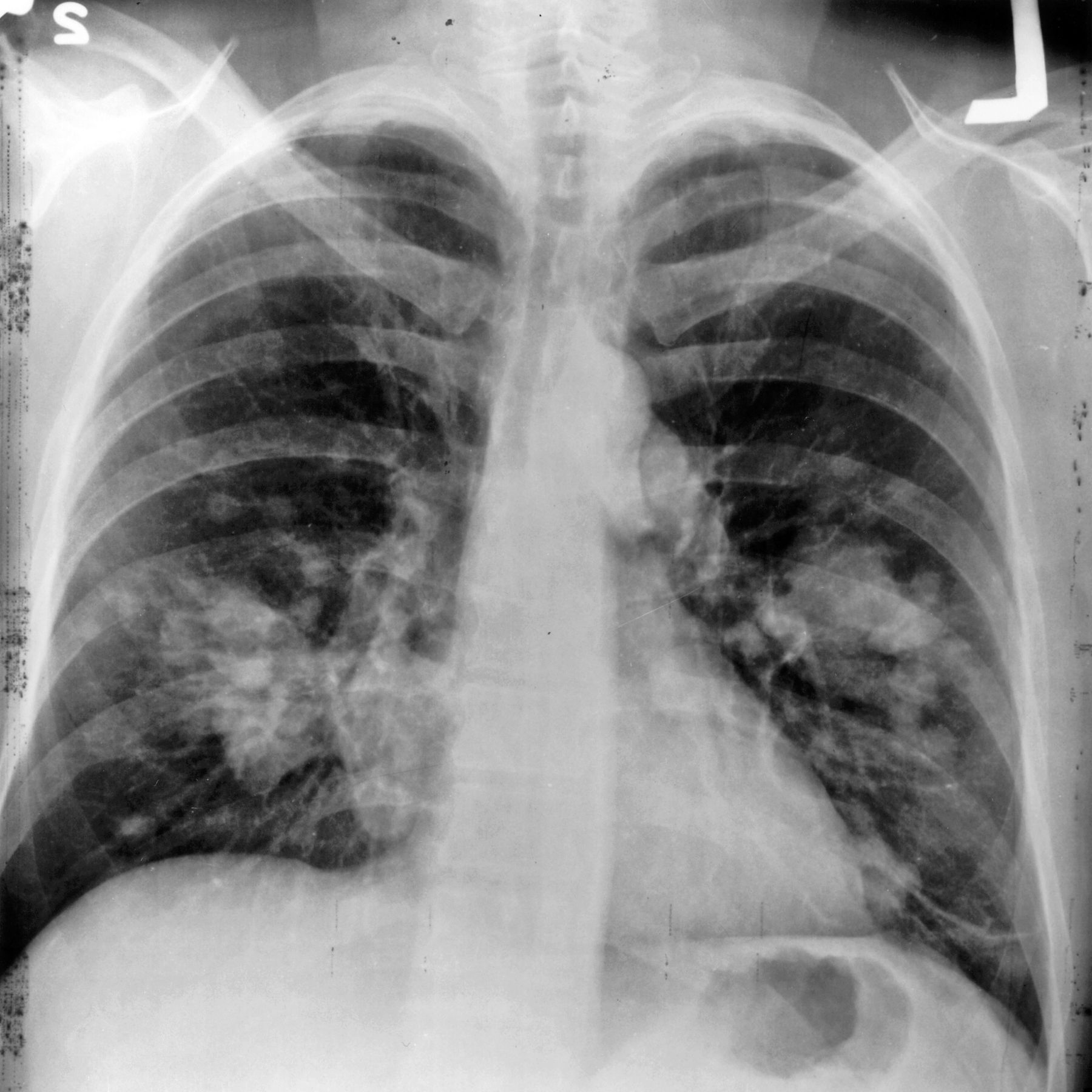 đ Skiktröntgen upptĂ€cker lungcancer i tid