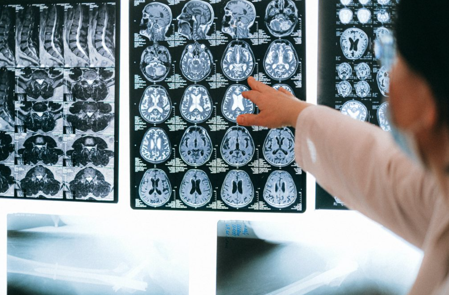 đ§ AI kan diagnosticera Alzheimers med över 99 procents sĂ€kerhet