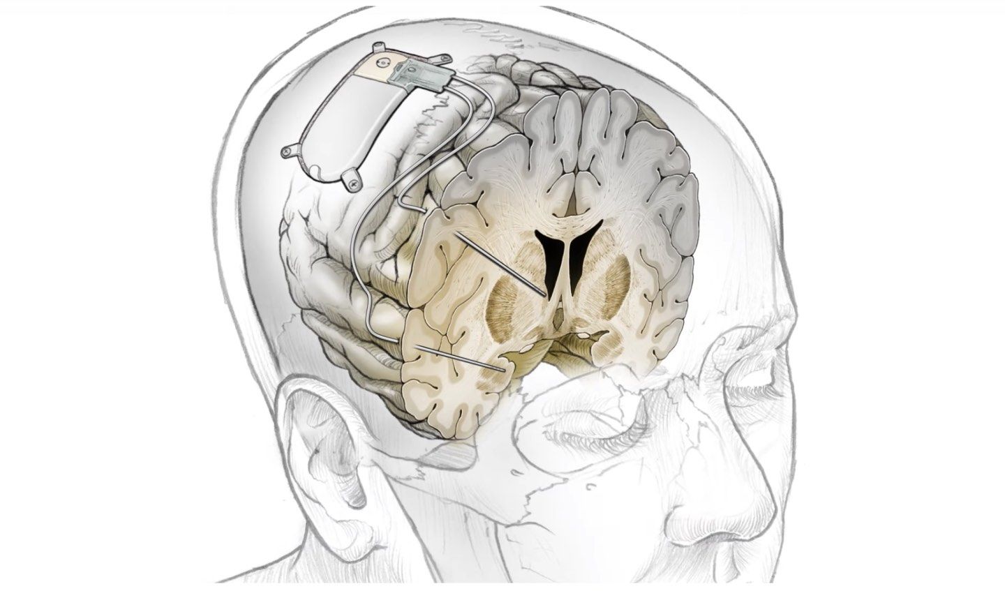 đ§ Kvinna blev botad frĂ„n depression med hjĂ€lp av implantat