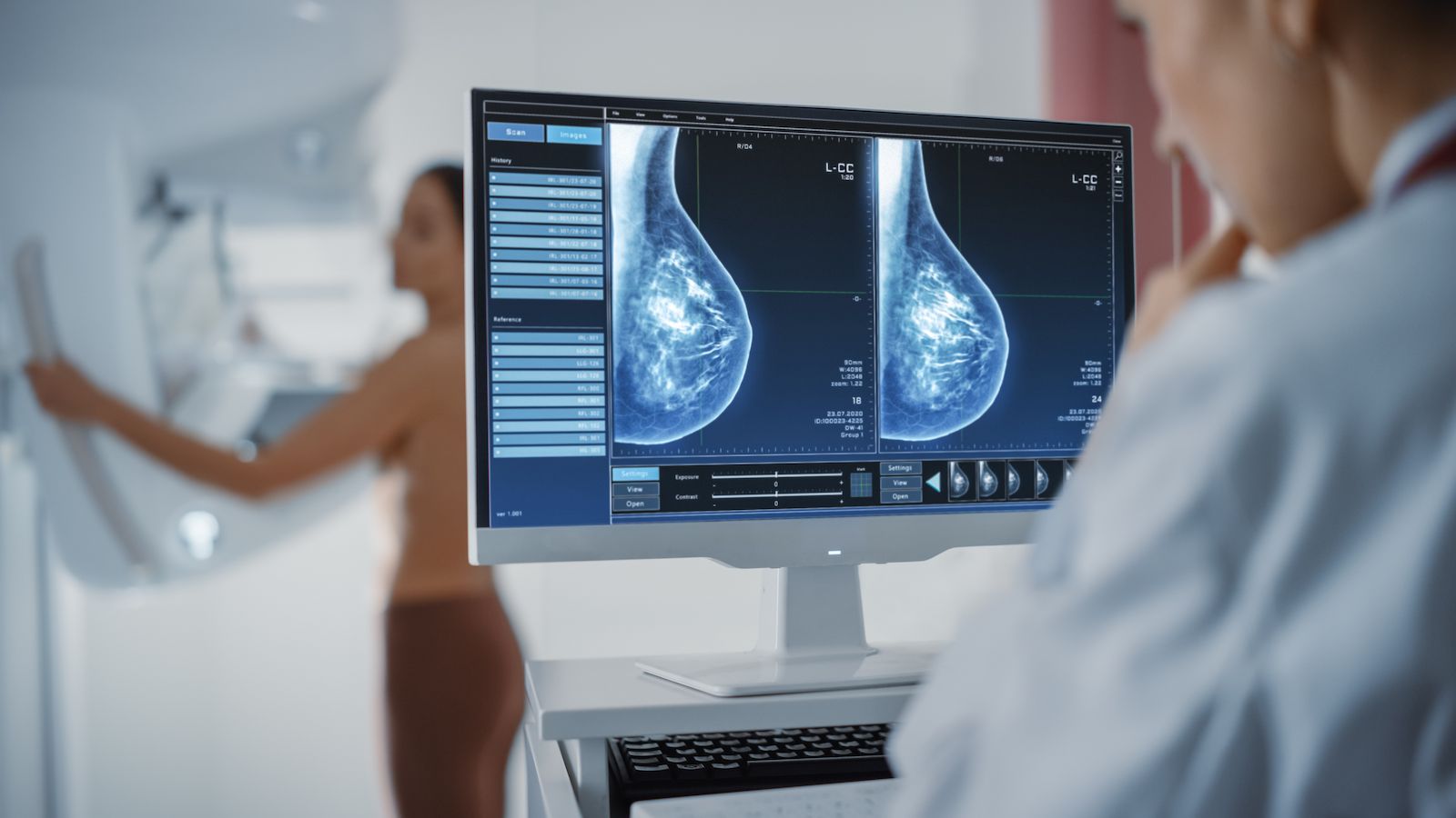 đïž Bröstcancer upptĂ€cks av AI + lĂ€kare - ny sorts granskning av mammografibilder pĂ„ St Göran
