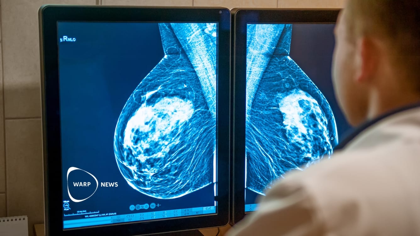 👩‍⚕️ AI-stödd mammografi minskar antalet missade cancerfall